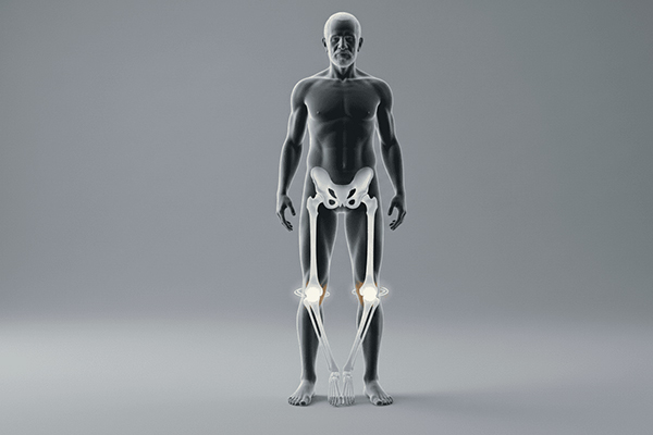 Bow Legs (Genu Varum)