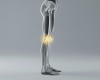 Genu Recurvatum (Knee Hyperextension)