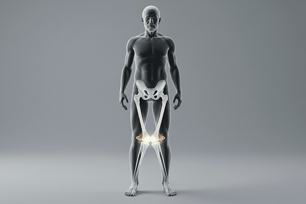 Knock Knees (Genu Valgum)